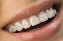 Orthodontic options for adults Farmington Valley Orthodontics offers adult orthodontic treatments